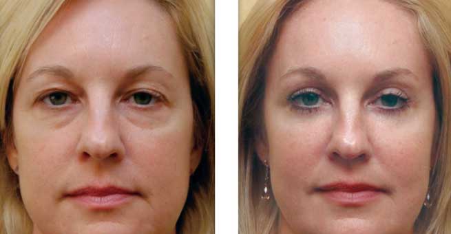 Is Blepharoplasty Right For You 