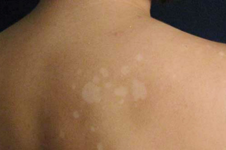 White Spots From Tanning Causes Home Remedies OTC Treatments