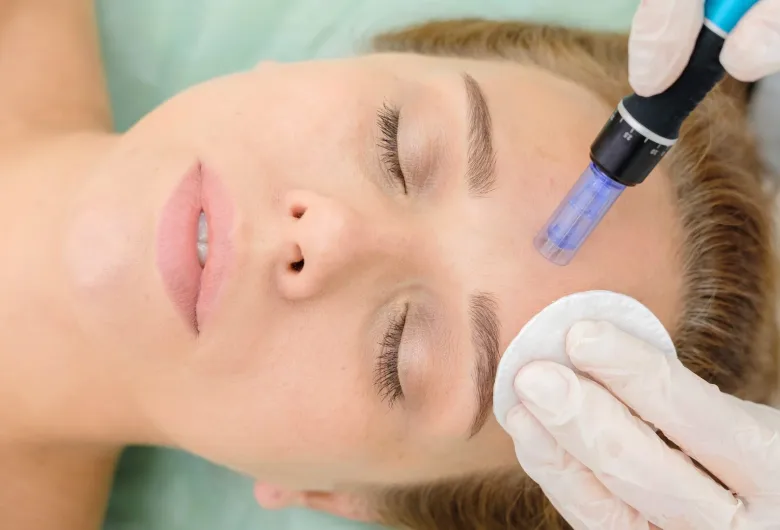 Microneedling